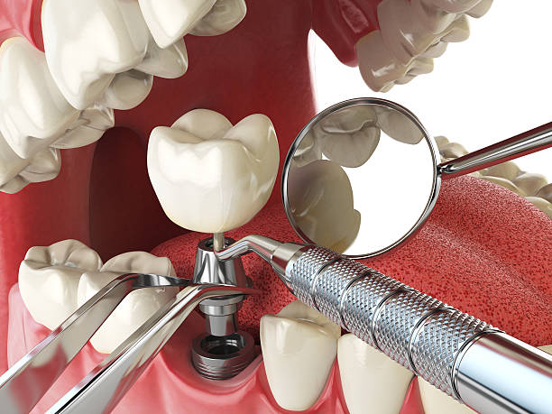 Best Emergency Root Canal Treatment in Villa Park, CA